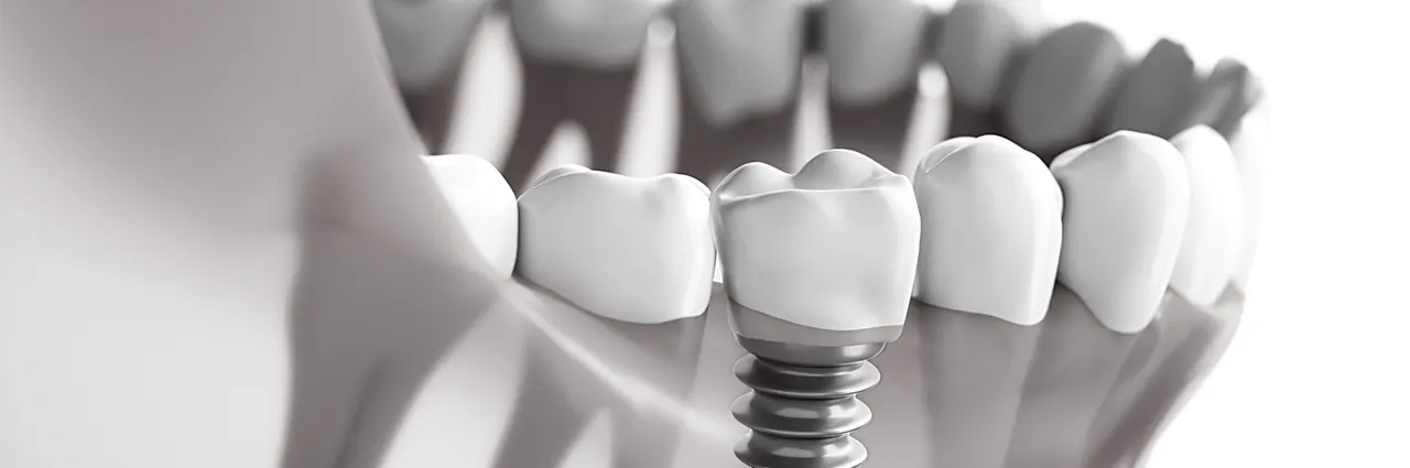 dental implants