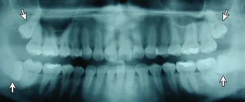 impacted wisdom teeth