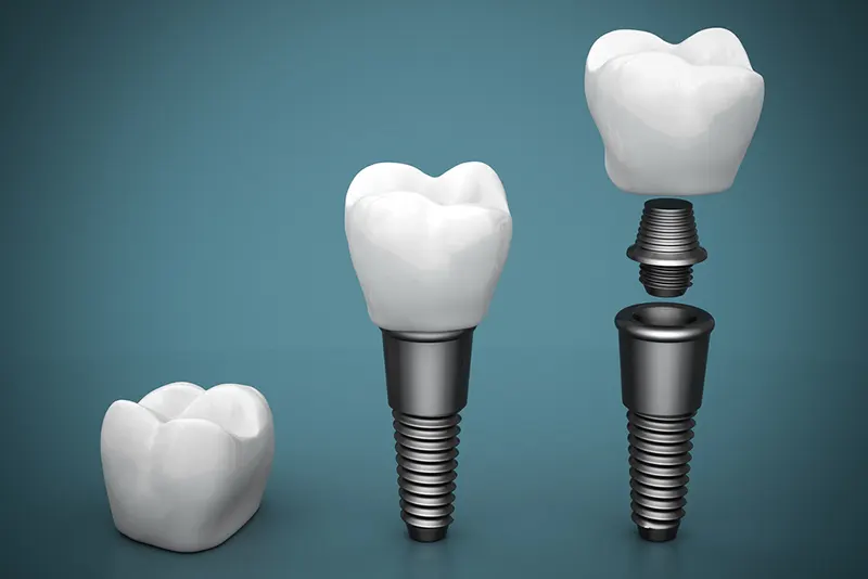 dentures and implants