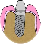 restorative implants step 2