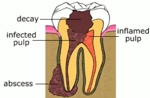 root canal