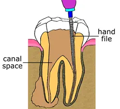 root canal step one