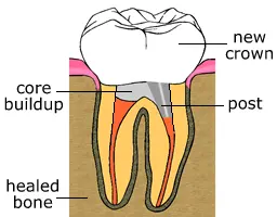 root canal step three