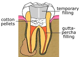 root canal step 2