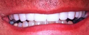 veneers