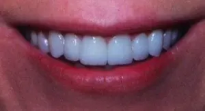 veneers