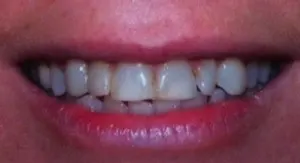 veneers